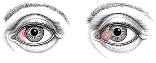 Pterygium St Augustine Trinidad West Indies, Precision Cataract Surgery